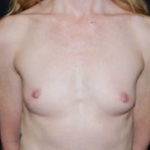 Breast Augmentation - Round Silicone Implants Before & After Patient #26134