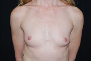 Breast Augmentation - Round Silicone Implants Before & After Patient #26134