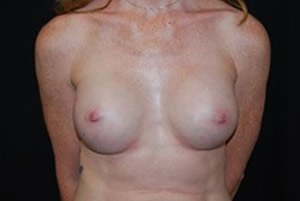 Breast Augmentation - Round Silicone Implants Before & After Patient #26134