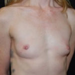 Breast Augmentation - Round Silicone Implants Before & After Patient #26134