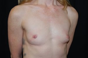 Breast Augmentation - Round Silicone Implants Before & After Patient #26134