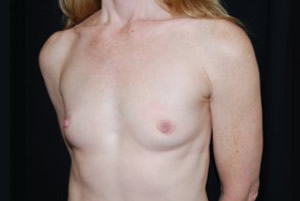 Breast Augmentation - Round Silicone Implants Before & After Patient #26134