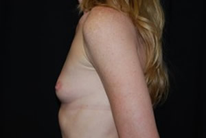 Breast Augmentation - Round Silicone Implants Before & After Patient #26134