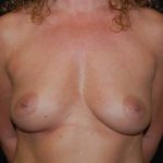 Breast Augmentation - Round Silicone Implants Before & After Patient #26154