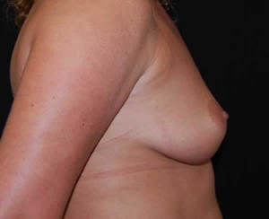 Breast Augmentation - Round Silicone Implants Before & After Patient #26154