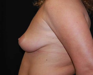Breast Augmentation - Round Silicone Implants Before & After Patient #26154