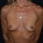 Breast Augmentation - Round Silicone Implants Before & After Patient #26165