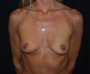 Breast Augmentation - Round Silicone Implants Before & After Patient #26165