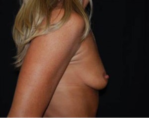Breast Augmentation - Round Silicone Implants Before & After Patient #26165