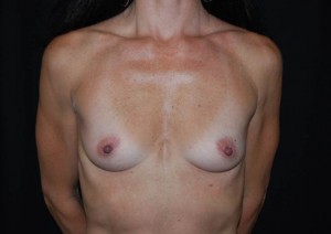 Breast Augmentation - Round Silicone Implants Before & After Patient #26187