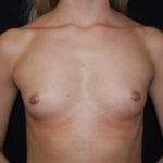 Breast Augmentation - Round Silicone Implants Before & After Patient #26198