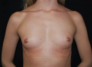 Breast Augmentation - Round Silicone Implants Before & After Patient #26198