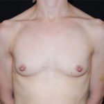 Breast Augmentation - Round Silicone Implants Before & After Patient #25793