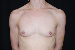 Breast Augmentation - Round Silicone Implants Before & After Patient #25793