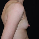 Breast Augmentation - Round Silicone Implants Before & After Patient #25793