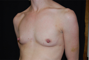 Breast Augmentation - Round Silicone Implants Before & After Patient #25793