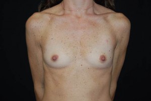 Breast Augmentation - Round Silicone Implants Before & After Patient #26220