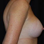 Breast Augmentation - Round Silicone Implants Before & After Patient #26231