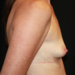 Breast Augmentation - Round Silicone Implants Before & After Patient #25804