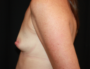 Breast Augmentation - Round Silicone Implants Before & After Patient #25804