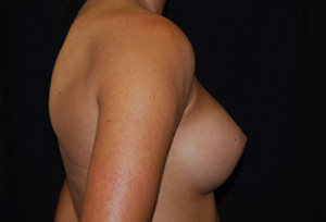 Breast Augmentation - Round Silicone Implants Before & After Patient #26264