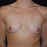 Breast Augmentation - Round Silicone Implants Before & After Patient #25851