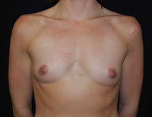 Breast Augmentation - Round Silicone Implants Before & After Patient #25851