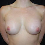 Breast Augmentation - Round Silicone Implants Before & After Patient #25851