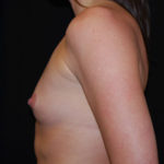 Breast Augmentation - Round Silicone Implants Before & After Patient #25851