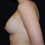 Breast Augmentation - Round Silicone Implants Before & After Patient #25851