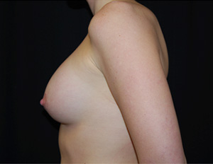 Breast Augmentation - Round Silicone Implants Before & After Patient #25851