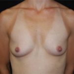 Breast Augmentation - Round Silicone Implants Before & After Patient #25858