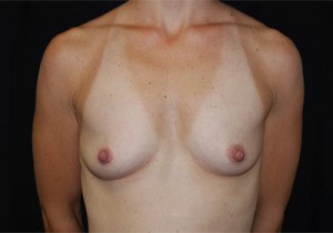 Breast Augmentation - Round Silicone Implants Before & After Patient #25858