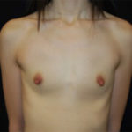 Breast Augmentation - Round Silicone Implants Before & After Patient #25869
