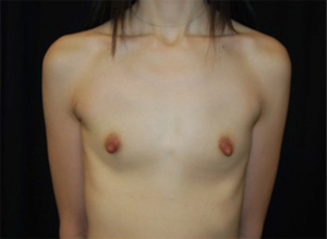 Breast Augmentation - Round Silicone Implants Before & After Patient #25869