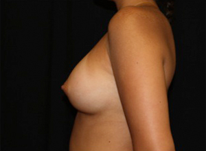 Breast Augmentation - Round Silicone Implants Before & After Patient #25880