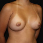 Breast Augmentation - Round Silicone Implants Before & After Patient #25880