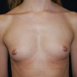 Breast Augmentation - Round Silicone Implants Before & After Patient #25891