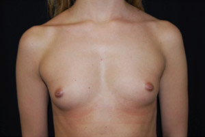 Breast Augmentation - Round Silicone Implants Before & After Patient #25891