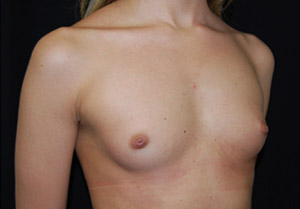 Breast Augmentation - Round Silicone Implants Before & After Patient #25891