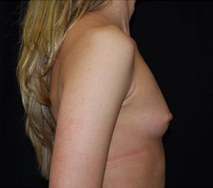 Breast Augmentation - Round Silicone Implants Before & After Patient #25891