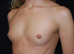 Breast Augmentation - Round Silicone Implants Before & After Patient #25891