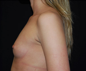 Breast Augmentation - Round Silicone Implants Before & After Patient #25891