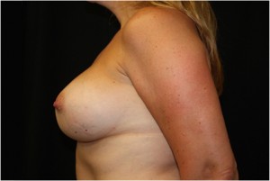 Breast Augmentation - Round Silicone Implants Before & After Patient #26275