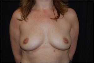 Breast Augmentation - Round Silicone Implants Before & After Patient #26275