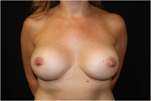 Breast Augmentation - Round Silicone Implants Before & After Patient #26275