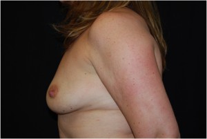 Breast Augmentation - Round Silicone Implants Before & After Patient #26275