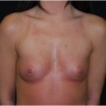 Breast Augmentation - Round Silicone Implants Before & After Patient #26286