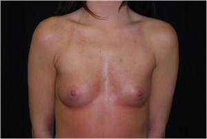 Breast Augmentation - Round Silicone Implants Before & After Patient #26286