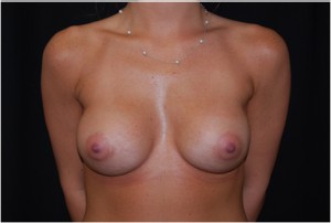 Breast Augmentation - Round Silicone Implants Before & After Patient #26286